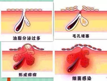 New&New|比春敏更痛苦的事...不要让爆痘毁了你的脸！