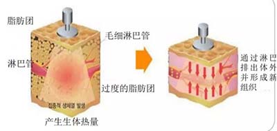 高周频溶脂塑身